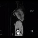 Angiolipoma, subcutaneous, selective embolisation: CT - Computed tomography
